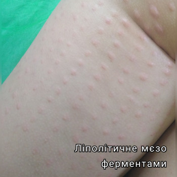 застосування ферментативного ліполітика