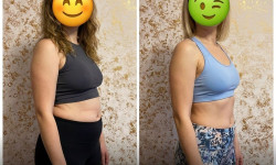 Криолиполиз 1 манипула Студия красоты Энжой Запорожье