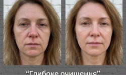 RF-лифтинг лицо + декольте Студия красоты Энжой Запорожье