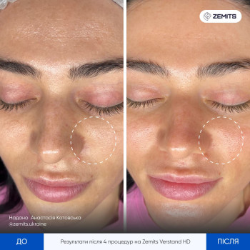 4 процедури