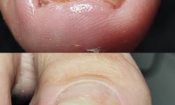 Корректирующие системы для ногтей Подолог Анна Одеса