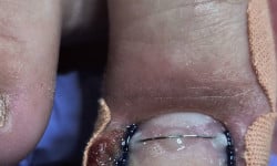 Обробка вросшего ногтя Студия красоты OH NAILS Одесса