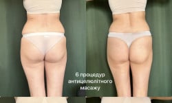 Антицеллюлитный массаж Масажист Кристина Харків