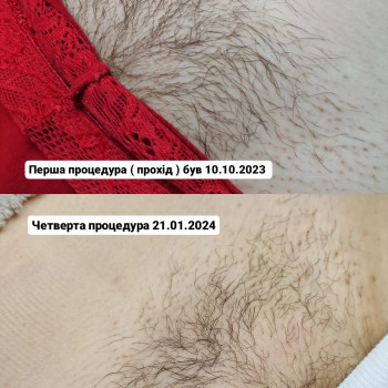 Бікіні Електроепіляція