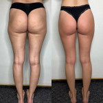 Антицеллюлитный массаж Косметолог Наталья Харків