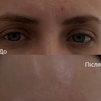 ботулінотерапія