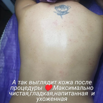 Результат после чистки спины