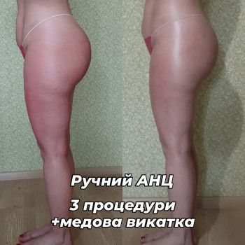 Проміжний результат ручного АНЦ масажу