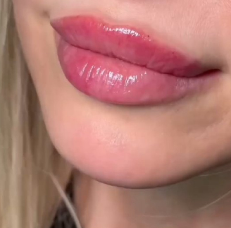 Збільшення губ контурна пластика аугментація, фото - Студія краси Beauty Line