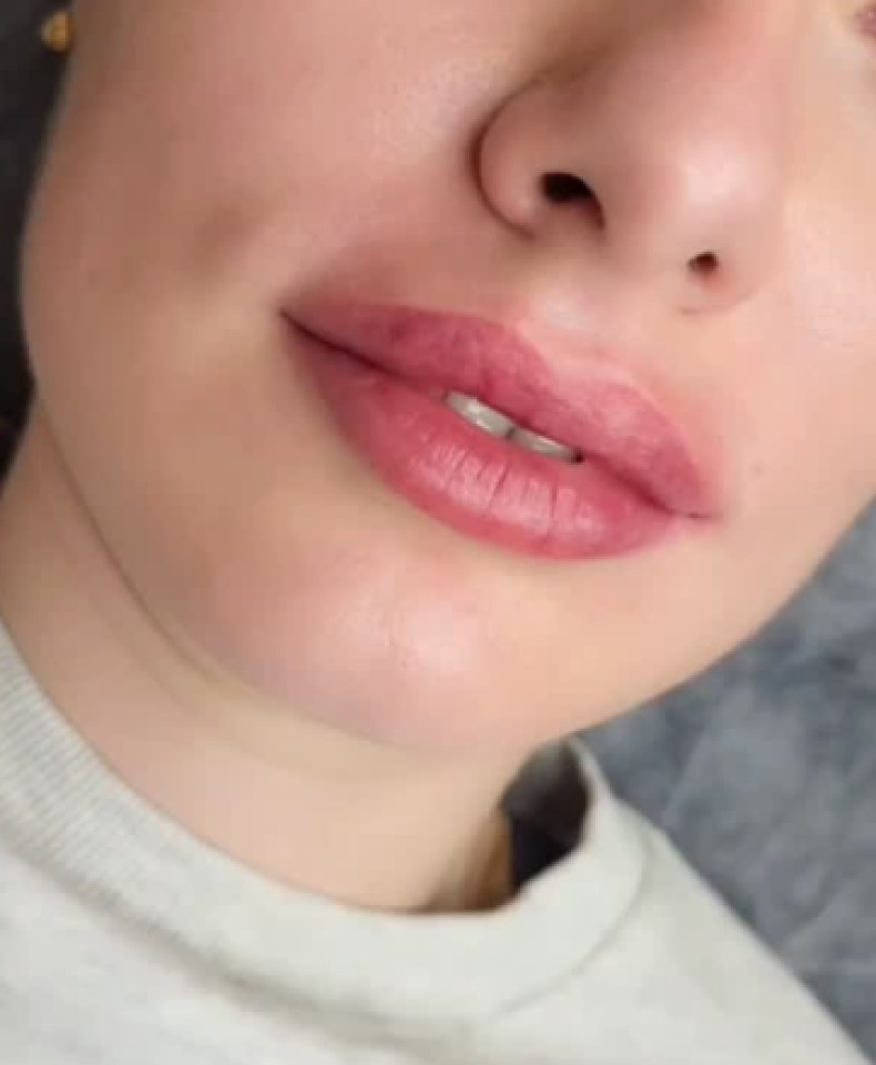 Збільшення губ контурна пластика аугментація, фото - Студія краси Beauty Line