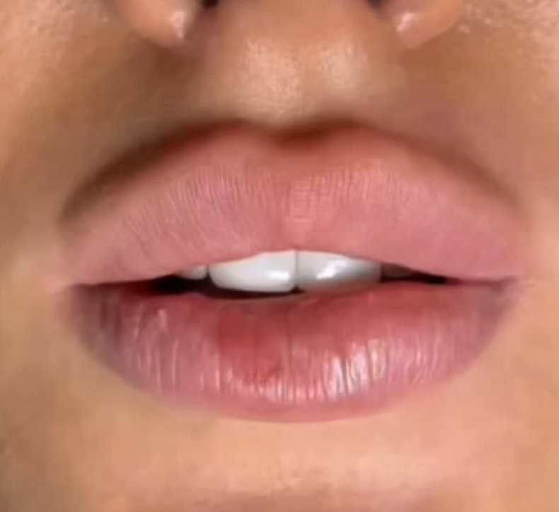 Збільшення губ контурна пластика аугментація, фото - Студія краси Beauty Line