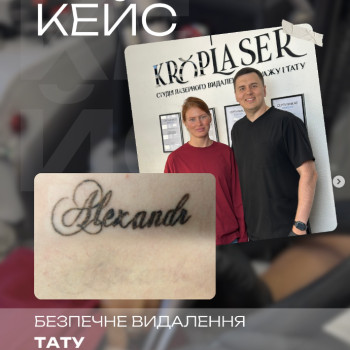 Професійне видалення татуажу брів. Результат після сеансу — шкіра чиста, без опіків та рубців.