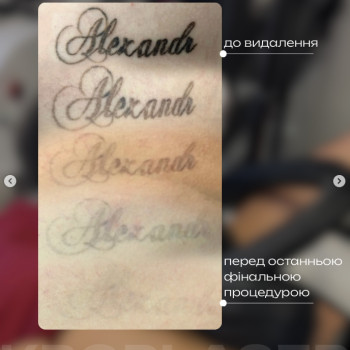 Професійне видалення татуажу брів. Результат після сеансу — шкіра чиста, без опіків та рубців.