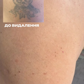 Професійне видалення татуажу брів. Результат після сеансу — шкіра чиста, без опіків та рубців.
