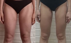 Лазерний ліполіз Косметологія Майстерня краси та здоров'я SLIM Дніпро