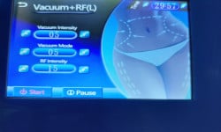 Вакуумный RF-лифтинг Косметология Майстерня краси та здоров'я SLIM Днепр