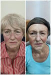Скульптурний масаж обличчя Косметолог-инъекционист Людмила Киев