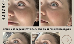 Масаж обличчя «Міофасціальний ліфтинг» Студія краси  Київ