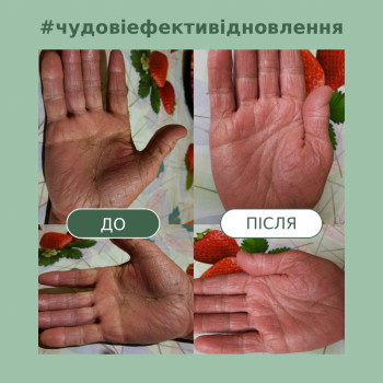 Суха емфізема рук понад 20років. З комплексним підходом відновлено повністю.