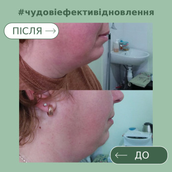 Підтяжка нижньої третини обличчя курсом ліполітиків