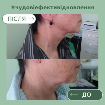 Омолодження за допомогою процедури Плазмоліфтинга