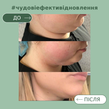 Підтяжка нижньої третини обличчя курсом ліполітика