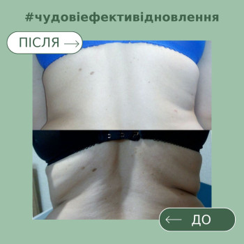 Контурування тіла курсом процедур ліполітика та кавітації.