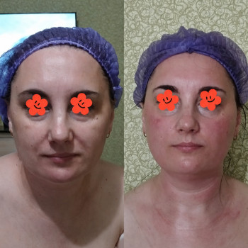 Лімфодренажний масаж обличчя,2 процедури масажу
