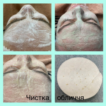 Чистка обличчя