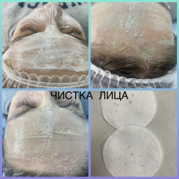 Механічна чистка обличчя