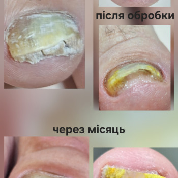 Звернення-зробіть щось. Нічого не допомогає. Дерматологи,подологи працювала. І результата не має. Пробуємо. Зміни є. Динаміка приросту є. Працюємо далі.