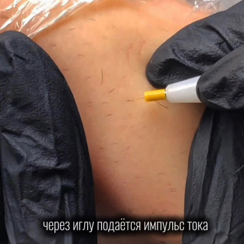 Гладенька шкіра без компромісів! Електроепіляція-перевірений метод видалення небажаного волосся назавжди. Чекаємо вас у студії косметології та епіляції Майї Філатової.
