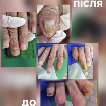 Руки літньої людини, яка не може за собою наглядати. Складна форма захворювання. Виїзд на обслуговування.