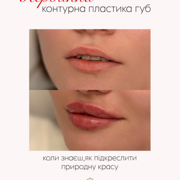 Первинне збільшення губ