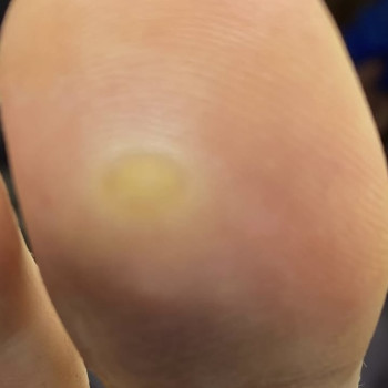 Бородовка вірусна🦠 ВПЛ ДО/