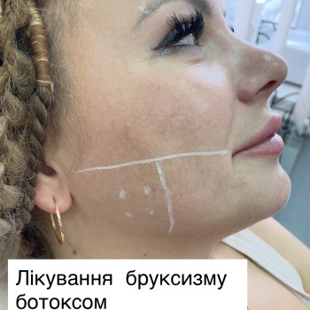 Лікування бруксизму ботоксом