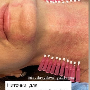 Тредліфтинг