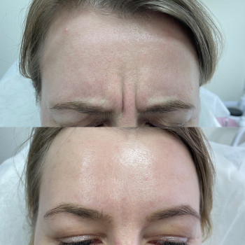 Botox міжбрівя