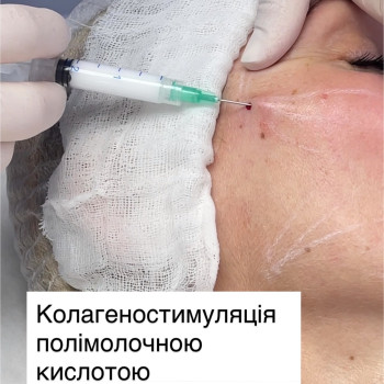 Полімолочна кислота