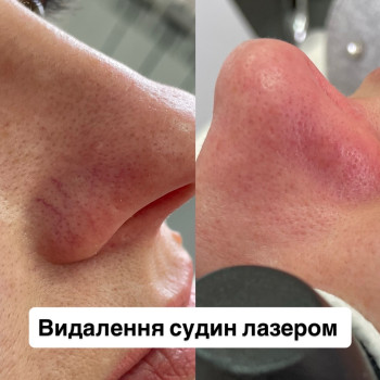 Видалення судин лазером