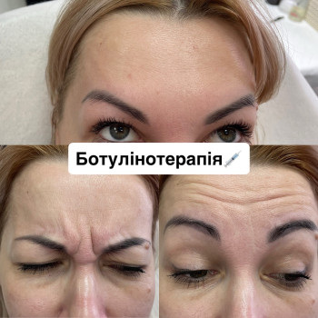 Botox