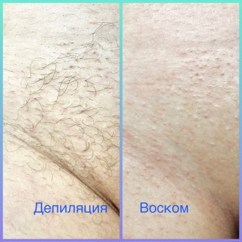 Депиляция зоны бикини воском
