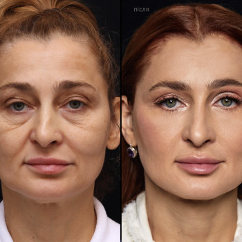 пластика обличчя - комплексне омолодження Face Up