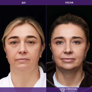 блефаропластика