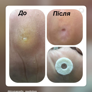 Видалення мозоля