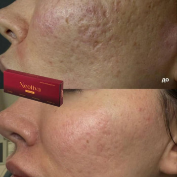 Подаруйте шкірі нове життя з рекомбінантним колагеном Neotiva Rh Collagen 🇰🇷 ℹ️ Це прорив в омолодженні і відновленні шкіри обличчя, шиї, декольте та рук, наповнюючи її сяйвом. ➡️ Унікальна формула сприяє поліпшенню контурів обличчя з делікатним ліфтинг-ефектом, пом’якшенню видимості шрамів і розтяжок, а також скорочує тонкі зморшки, завдяки чому шкіра виглядає помітно більш молодою та свіжою. ‼️ Рекомбінантний колаген Neotiva імітує натуральний людський колаген 3 типу, що виготовлений з