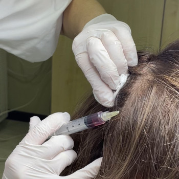 Мезотерапія шкіри голови✅ Препарат Hair+