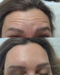 BOTOX  (три зони - знижка) Врач-косметолог Олеся Тернополь
