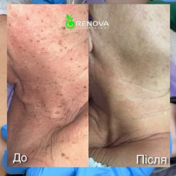 Фото с портфолио Renova