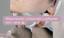 Мікронідлінг Dr.Pen Косметология Doskonala Киев